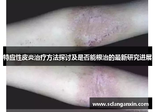 特应性皮炎治疗方法探讨及是否能根治的最新研究进展